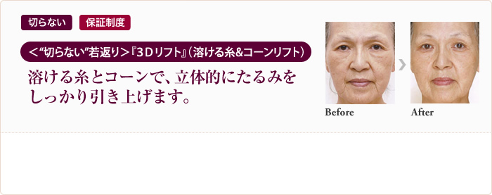 切らない 保証制度 ＜“切らない”若返り＞『３Ｄリフト』（溶ける糸&コーンリフト）溶ける糸とコーンで、立体的にたるみをしっかり引き上げます。