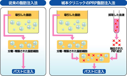 PRP脂肪注入法の図