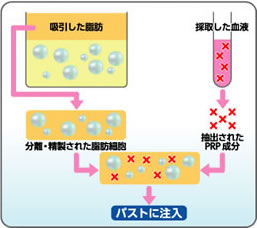 PRP脂肪注入法の図