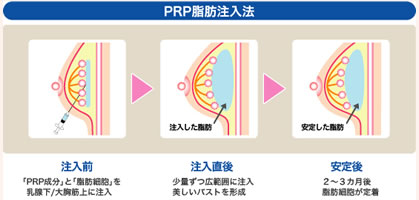 PRP脂肪注入法の注入図