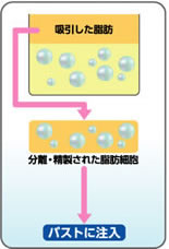 PRP脂肪注入法の図