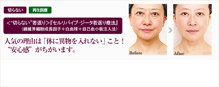 切らない 再生医療 ＜“切らない”若返り＞『セルリバイブ･ジータ若返り療法』（線維芽細胞成長因子＋白血球＋自己血小板注入法）人気の理由は「体に異物を入れない」こと！“安心感”がちがいます。