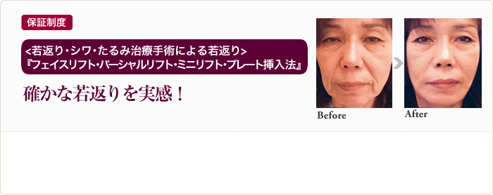 保証制度 ＜若返り・しわ・たるみ治療手術による若返り ＞『フェイスリフト・パーシャルリフト・ミニリフト・プレート挿入法』確かな若返りを実感！