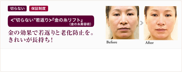 切らない 保証制度 ＜“切らない”若返り＞『金の糸リフト』（金の糸美容術）金の効果で若返りと老化防止を。きれいが長持ち！