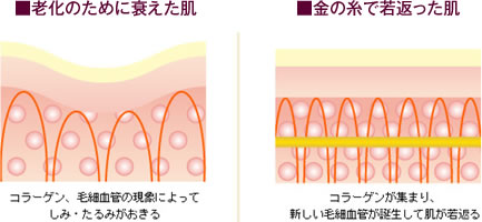 ■老化のために衰えた肌「コラーゲン、毛細血管の現象によってしみ・たるみがおきる」 ■金の糸で若返った肌「コラーゲンが集まり、新しい毛細血管が誕生して肌が若返る」