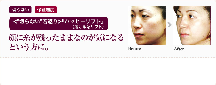 切らない 保証制度 ＜“切らない”若返り＞『ハッピーリフト』（溶ける糸リフト） 顔に糸が残ったままなのが気になるという方に。