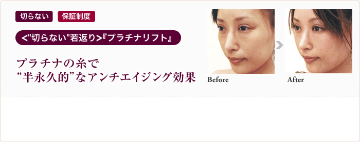 切らない 保証制度 ＜“切らない”若返り＞『プラチナリフト』プラチナの糸で“半永久的”なアンチエィジング効果