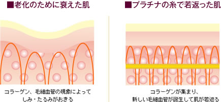 ■老化のために衰えた肌「コラーゲン、毛細血管の現象によってしみ・たるみがおきる」 ■プラチナの糸で若返った肌「コラーゲンが集まり、新しい毛細血管が誕生して肌が若返る」