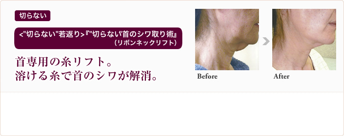 切らない ＜“切らない”若返り＞『“切らない”首のシワ取り術』（リボンネックリフト）首専用の糸リフト。溶ける糸で首のシワが解消。