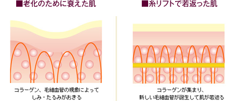 ■老化のために衰えた肌 ■糸リフトで若返った肌