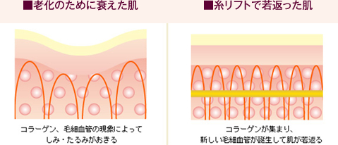 ■老化のために衰えた肌と■糸リフトで若返った肌