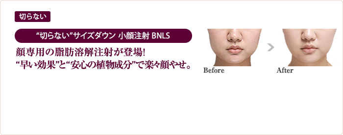 切らない ＜“切らない”サイズダウン＞小顔注射 BNLS