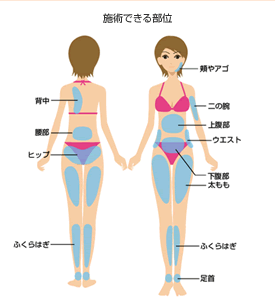 脂肪吸引できる箇所