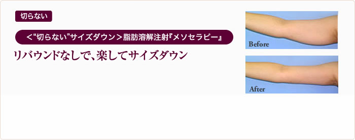 切らない ＜“切らない”サイズダウン＞脂肪溶解注射『メソセラピー』リバウンドなしで、楽してサイズダウン