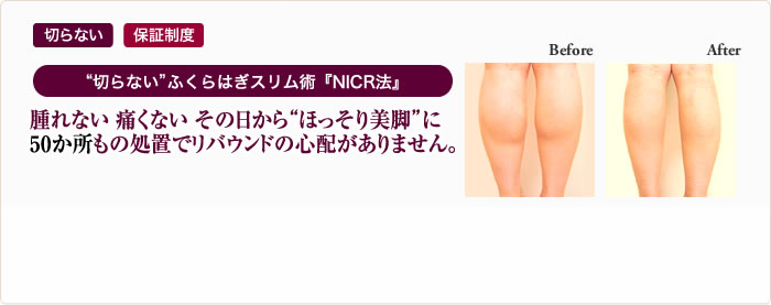 “切らない”ふくらはぎスリム術『NICR法』腫れない 痛くない その日から“ほっそり美脚”に50か所もの処置でリバウンドの心配がありません。