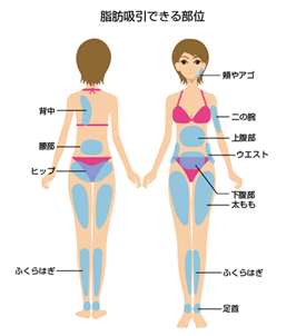 脂肪吸引できる箇所