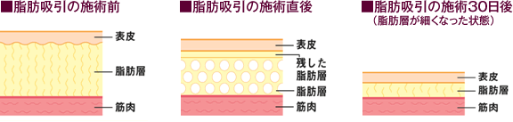 脂肪吸引の施術前,脂肪吸引の施術直後,脂肪吸引の施術３０日後 