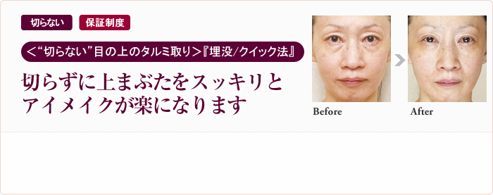 切らない 保証制度 “切らない”目の上のタルミ取り 『埋没／クイック法』切らずに上まぶたをスッキリとアイメイクが楽になります