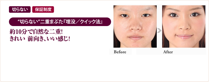 “切らない”二重まぶた『埋没／クイック法』約10分で自然な二重！きれい 前向き、いい感じ！