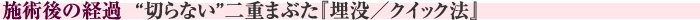 施術後の経過　“切らない”二重まぶた『埋没／クイック法』