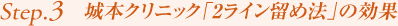 Step3. 城本クリニック「2ライン留め法」の効果