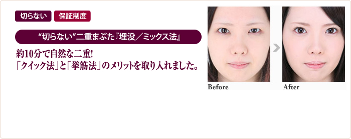 注射で"ワキ汗・手汗・足汗"を制御!＜ワキガ・多汗症治療＞『ボトックス注入法』（ALLERGAN社製） 切らずにワキガ・多汗症の治療をしたいという方にオススメ ワキ汗・手汗・足汗でお悩みの方にオススメ