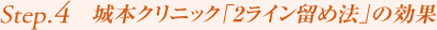 Step4. 城本クリニック「2ライン留め法」の効果