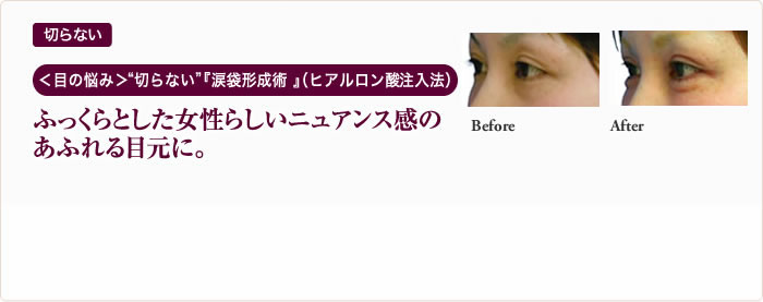 切らない ＜目の悩み＞“切らない”『涙袋形成術 』（ヒアルロン酸注入法）ふっくらとした女性らしいニュアンス感のあふれる目元に。