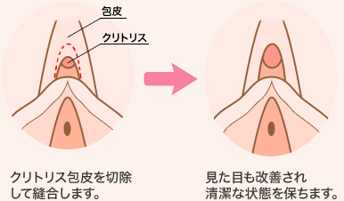 クリトリス包皮を切除して縫合します。　見た目も改善され清潔な状態を保ちます。