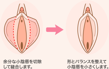 余分な小陰唇を切除して縫合します。　形とバランスを整えて小陰唇を小さくします。