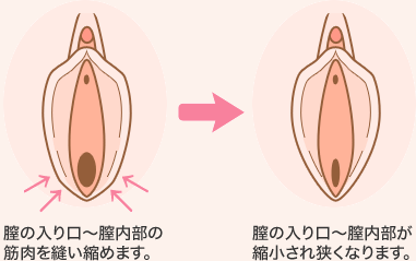 膣の入り口～膣内部の筋肉を縫い縮めます。　膣の入り口～膣内部が縮小され狭くなります。