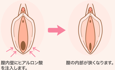 膣内壁にヒアルロン酸を注入します。 膣の内部が狭くなります。