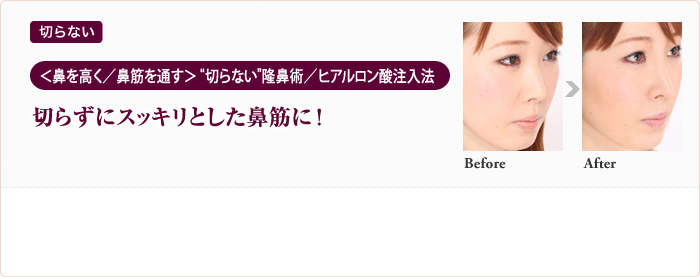 切らない ＜  鼻を高く／鼻筋を通す＞   “切らない”隆鼻術／ヒアルロン酸注入法 切らずにスッキリとした鼻筋に！