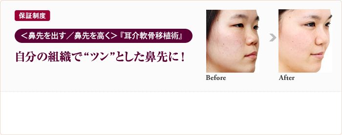 保証制度 ＜鼻先を出す／鼻先を高く＞「耳介軟骨移植術」自分の組織で“ツン”とした鼻先に！