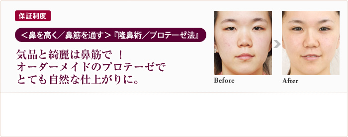 保証制度 ＜鼻を高く／鼻筋を通す＞「隆鼻術／プロテーゼ法」気品と綺麗は鼻筋で! オーダーメイドのプロテーゼでとても自然な仕上がりに。