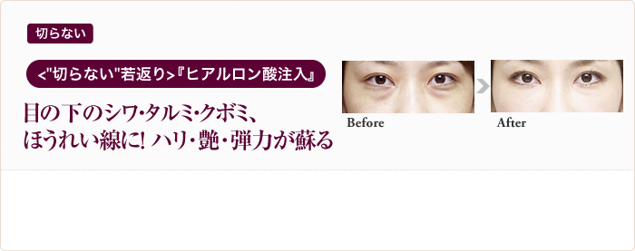 切らない ＜“切らない”若返り＞『ヒアルロン酸注入』 目の下のタルミやクボミ、ほうれい線にハリ・艶・弾力が甦る