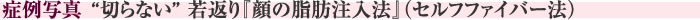 症例写真　“切らない” 若返り『顔の脂肪注入法』(セルフファイバー法)