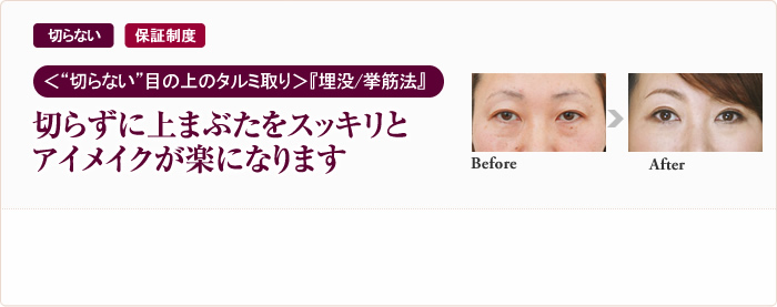 切らない 保証制度 “切らない”目の上のタルミ取り『埋没/挙筋法』切らずに上まぶたをスッキリとアイメイクが楽になります