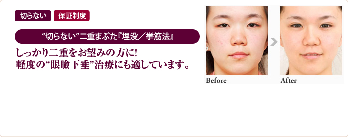 しっかり二重をお望みの方に！軽度の“眼瞼下垂”治療にも適しています。