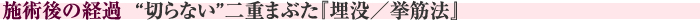 施術後の経過　“切らない”二重まぶた『埋没／挙筋法』