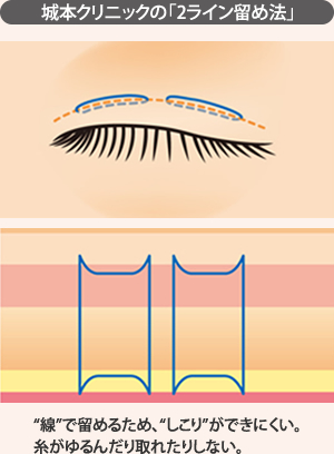 城本クリニックの「2ライン留め法」