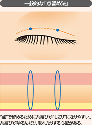 一般的な「点留め法」